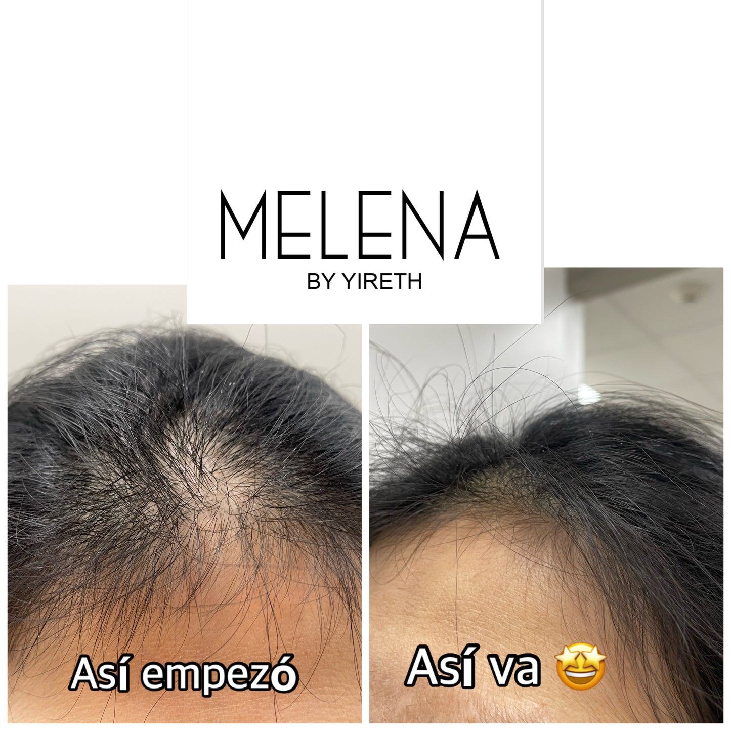 🌿 Melena Magic Kit – Heal Hair Damage & Regain Fullness🌱 FREE SHIPPING💕